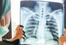 Nuevo tratamiento aumenta la supervivencia en pacientes con cáncer de pulmón