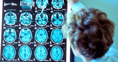 20241106 Cerebro 1 enfermedades neurodegenerativas