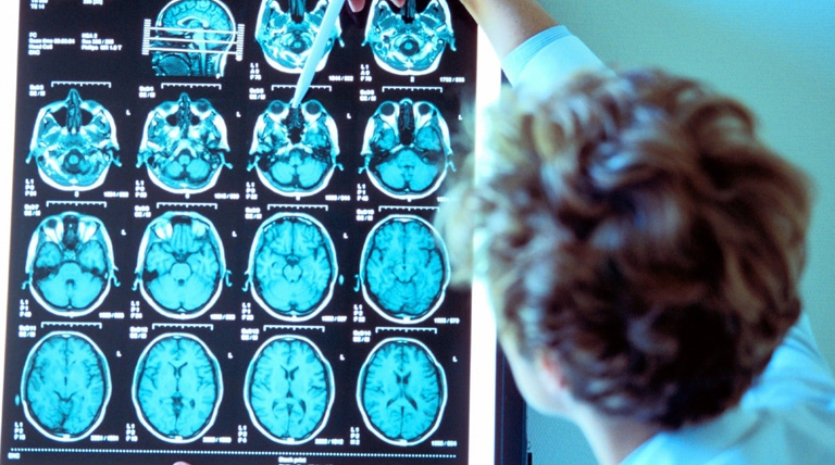 Un estudio revela el vínculo entre trastornos digestivos y enfermedades neurodegenerativas 1 20241106 Cerebro 1 enfermedades neurodegenerativas