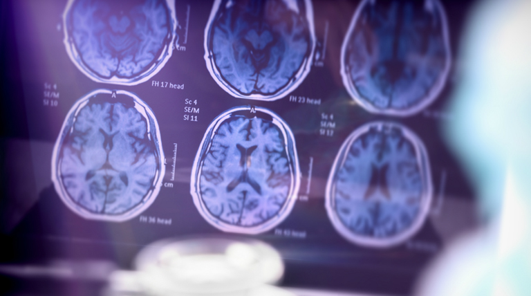 Riesgo de Alzheimer: Estudio advierte que saberlo baja el entusiasmo por hábitos saludables, pese a no dañar la salud mental 1 20250508 Alzheimer Alzheimer