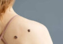 Alerta por Melanoma: proyecciones de un crecimiento superior al 50% en 20 años Alerta por Melanoma: proyecciones de un crecimiento superior al 50% en 20 años