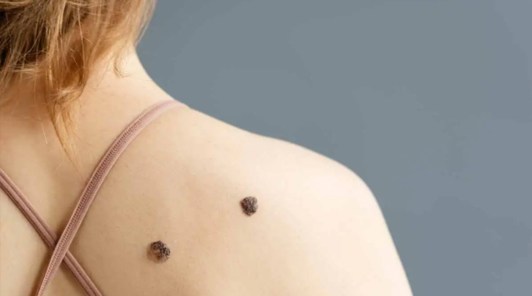 Melanoma