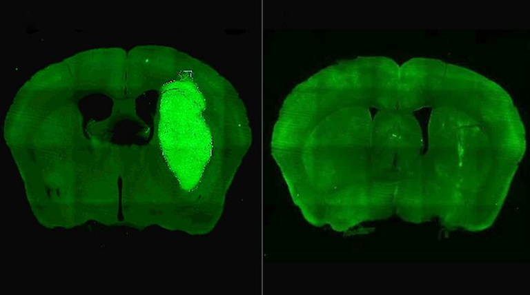 Un estudio del CONICET logra frenar un tipo de cáncer cerebral en modelos preclínicos 1 Cancer Cerebral