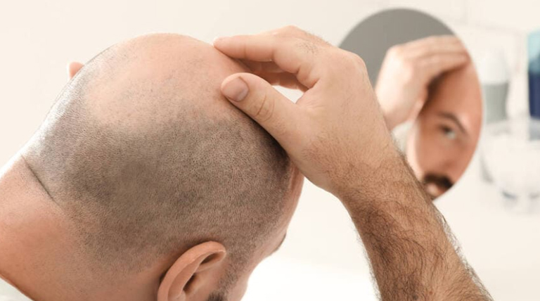 20260220 alopecia alopecia